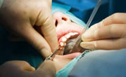 Cirurgia dentistica em Avaré Odontologia em Avaré Odontoclassic