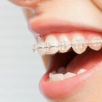Ortodontia em Avaré Modue Osontologia
